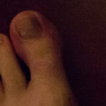 Roesing Toe