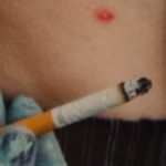 Painted Fingers Cigarette Bug Bites